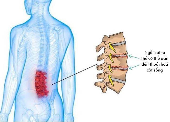 Thời gian dài ngồi sai tư thế khi làm việc có thể dẫn đến thoái hoá cột sống